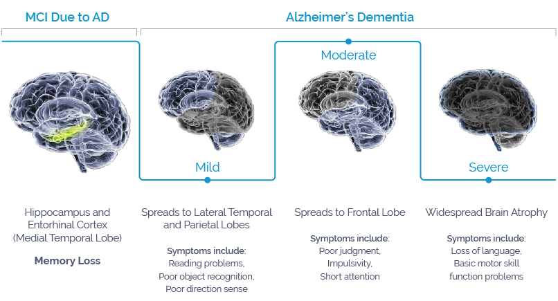 Alzheimer's Disease Progression